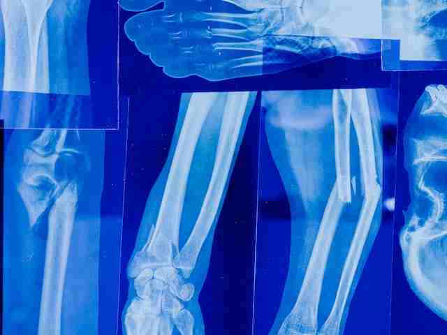 ऑस्टियोपोरोसिस-के-कारण-लक्षण-व-इलाज-osteoporosis-in-hindi