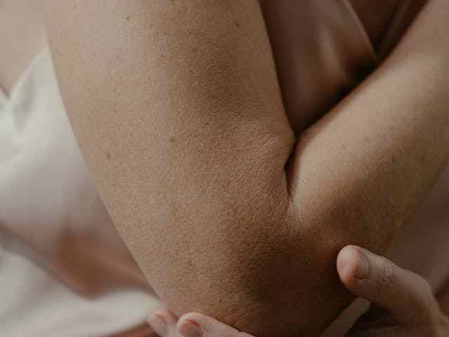 बर्साइटिस-के-लक्षण-कारण-रोकथाम-इलाज-bursitis-in-hindi