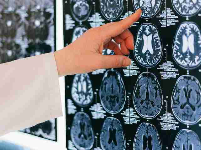 माइग्रेन-अधकपारी-का-लक्षण-निदान-इलाज-migraine-treatment-in-hindi